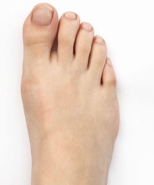I cured thumb valgus with Hondro Sol Valgus spray