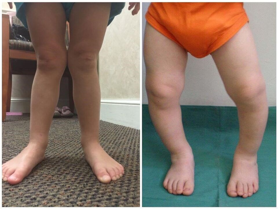 Valgus deformation in children causing