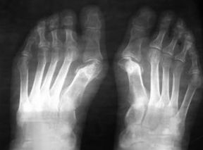 Indications for operations under the valgus of the foot