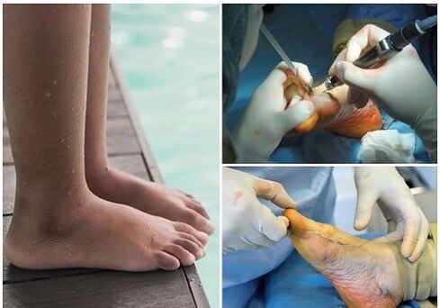 A little invasive surgical treatment