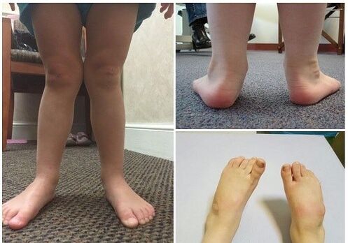 Valgus deformation in children