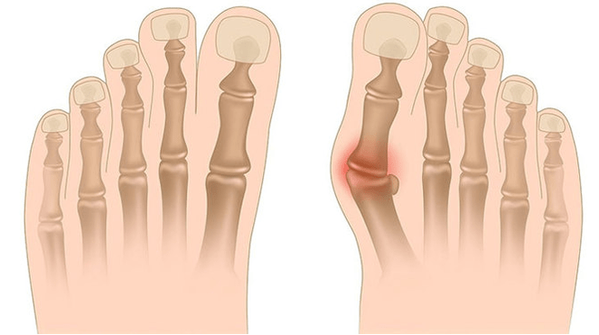 Valgus deformation treatment
