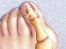Hallux Valgus deformation