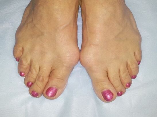 Hallux Valgus's deformation