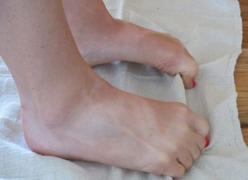 Exercise for the foot with a deformed big toe