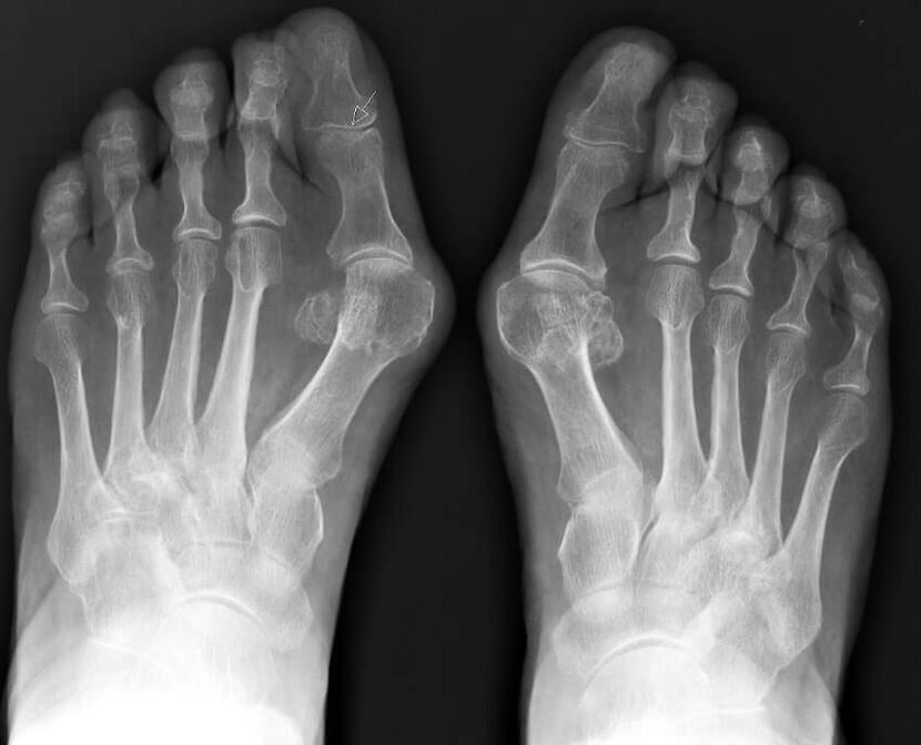 X-ray of hallux valgus